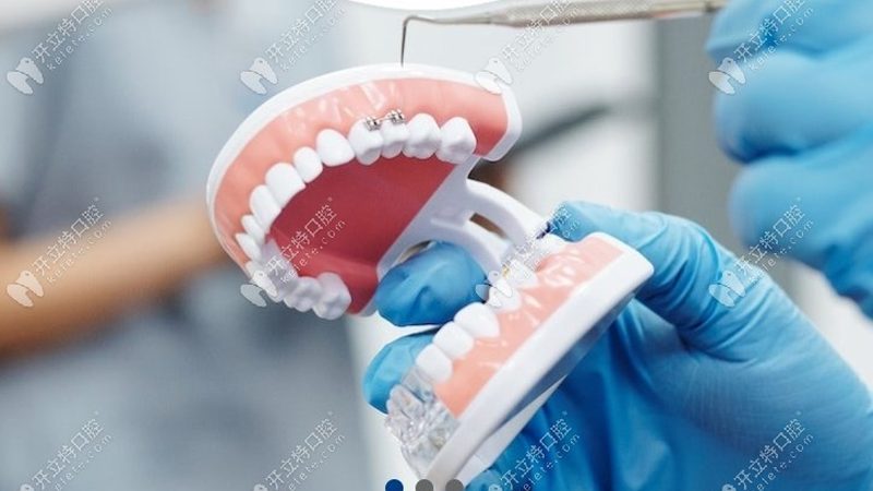 儿童牙齿矫正，矫正器分类与价格解析